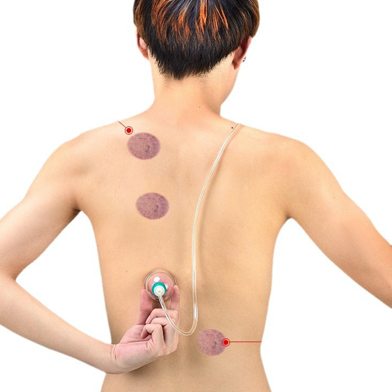 ⏳ Tijdelijke aanbieding⏰ Cuppingtherapie set met vacuümbekers – verdikt, met zuigpomp, transparant 🩺